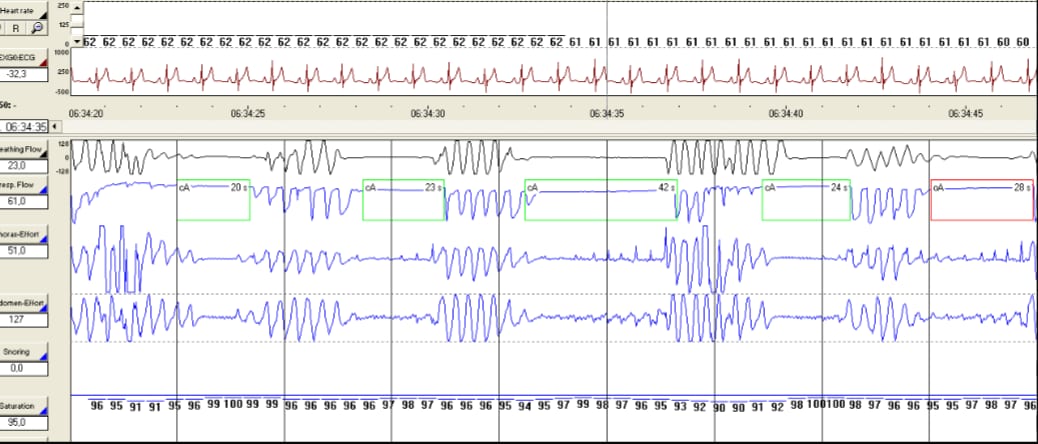 A screen from an overnight sleep study, with a heart rhythm trace at the top and breathing and oxygen signals below